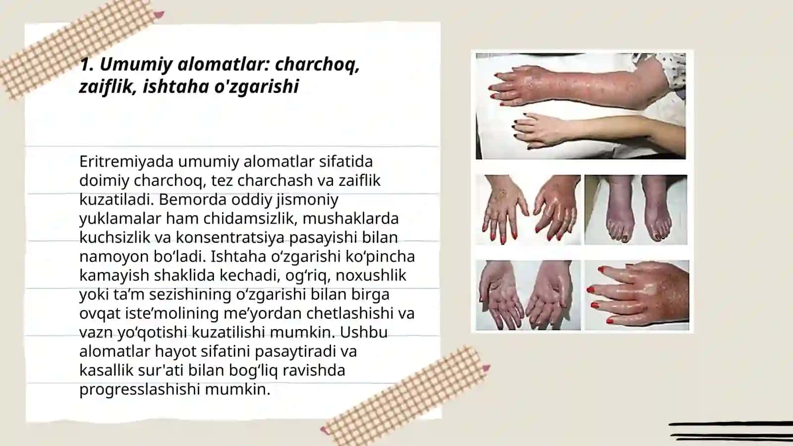 Eritremiya simptamotologiyasi 3