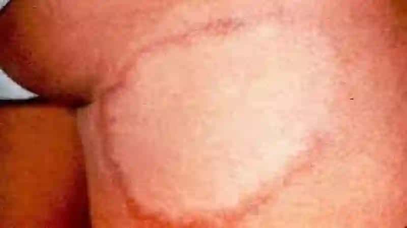 Dermatoz 3