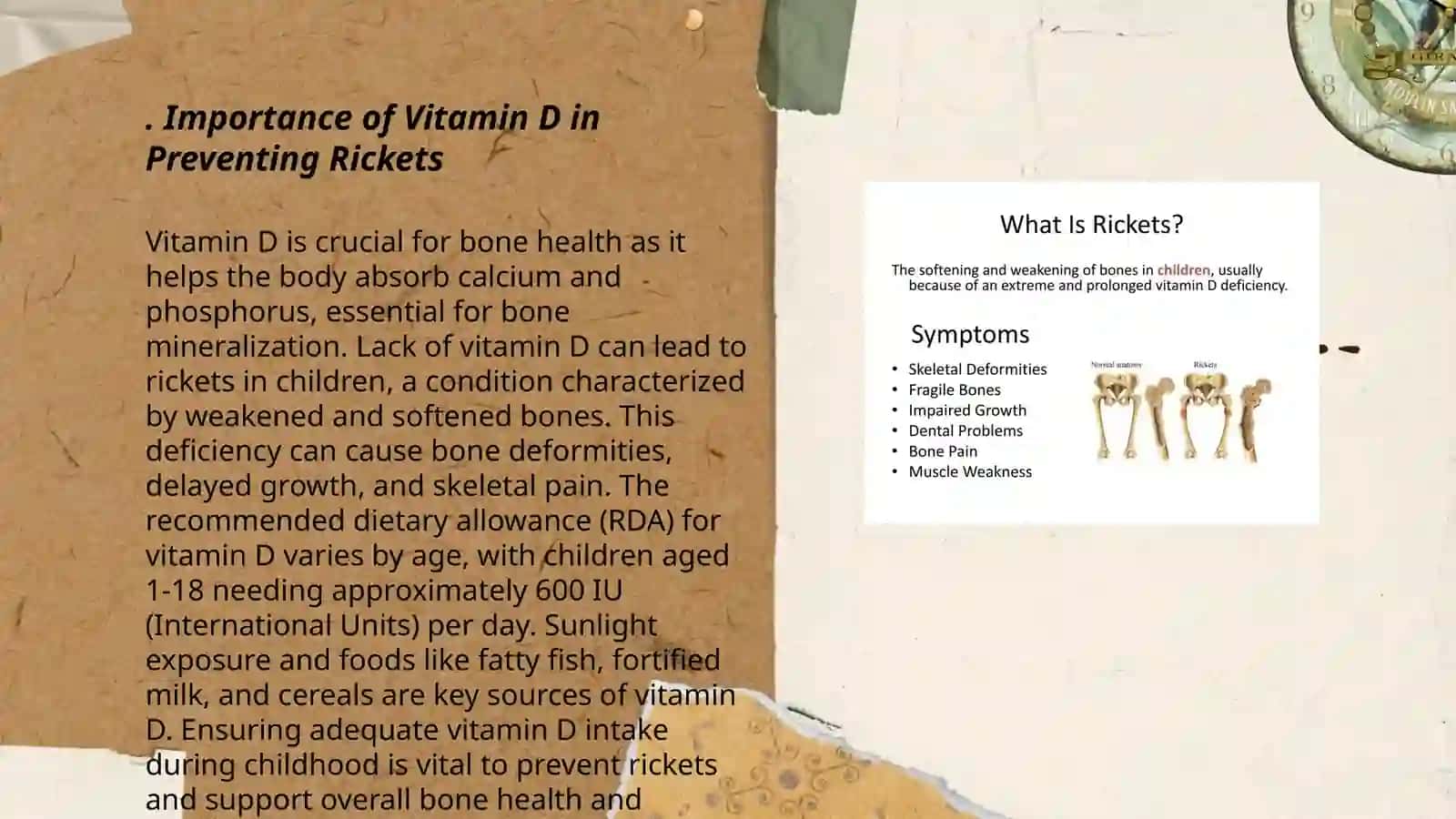 Prevention of rickets in children 3