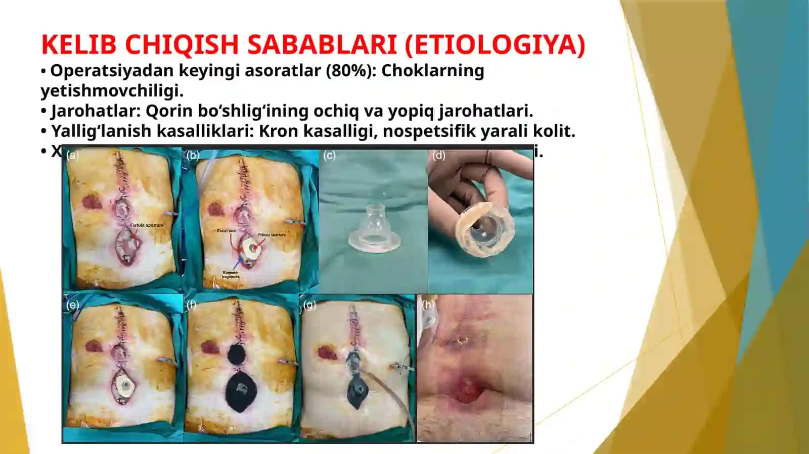 ICHAK OQMA YARALARINIBARTARAF QILISH USULLARI 3