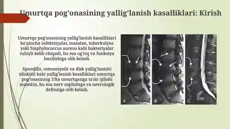 Umurtqa yallig‘lanish va degenerativ-distrofik kasalliklari 3