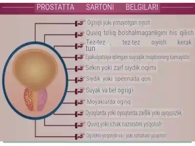 Prostatabezio’smalari 3