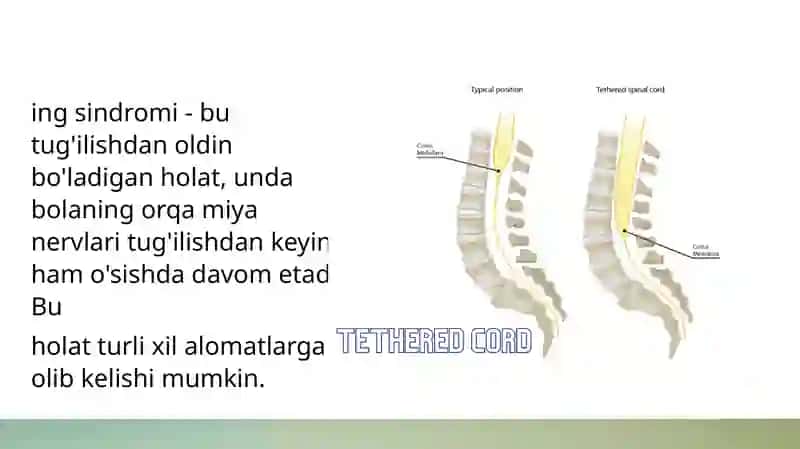 Tetringsindrom 3