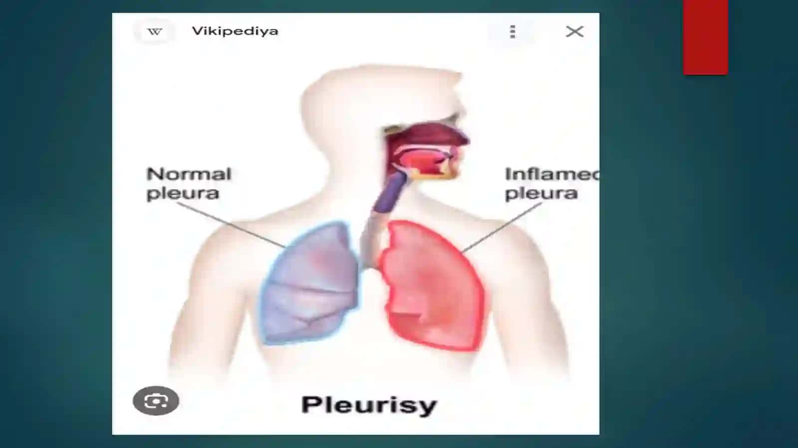 Ekssudativ plevrit 3