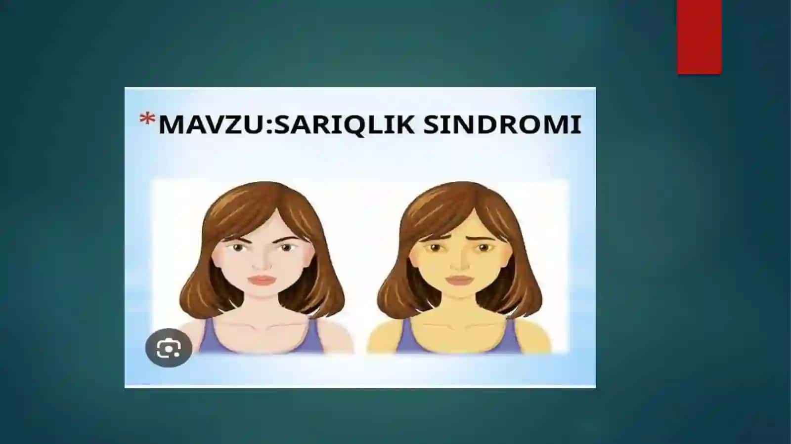 JIGAR VA O‘T PUFAGI KASALLIKLARIDAGI ASOSIY KLINIK SINDROMLAR 3