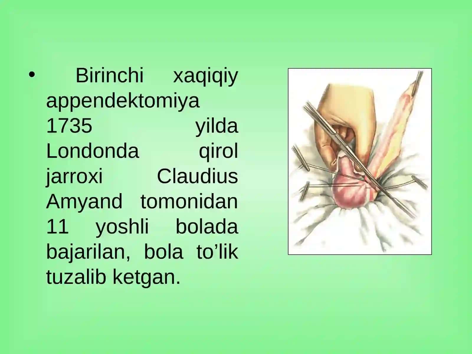 O'tkir appenditsit va uning asoratlari 3