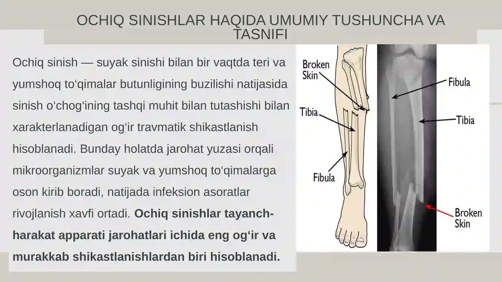 OCHIQ SINISHLAR. TRAVMATIK OSTEOMIYELIT 3