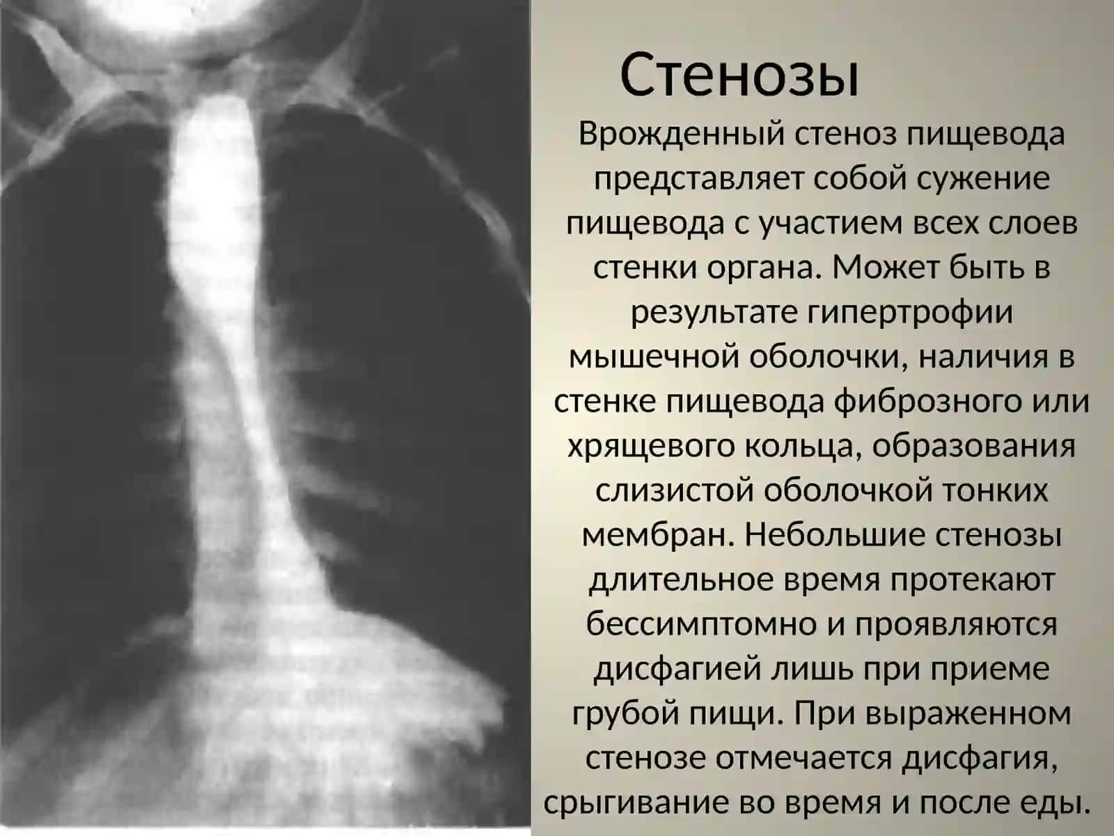 Аномалии развития пищевода 3
