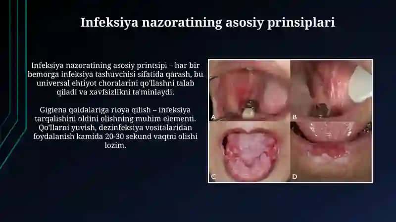 Stomatologik amaliyotda OIV infeksiyasi va virusli gepatitlarning oldini olish choralari 3