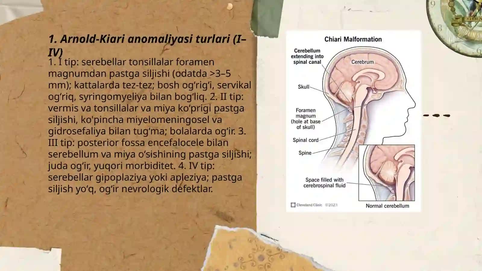 Arnold-Kiari anomaliyasi 3