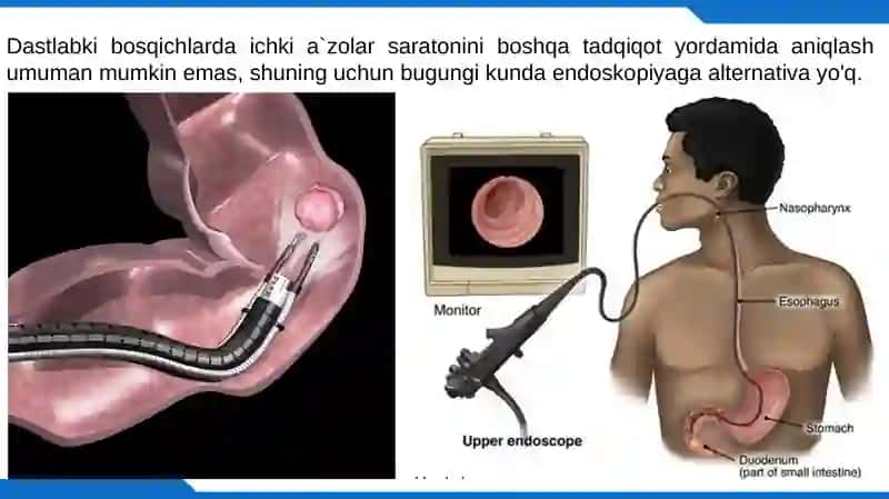 Endoskopiya 3