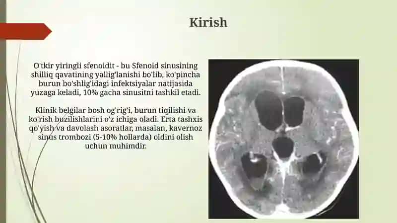 O'tkir yiringli sfenoidit 3