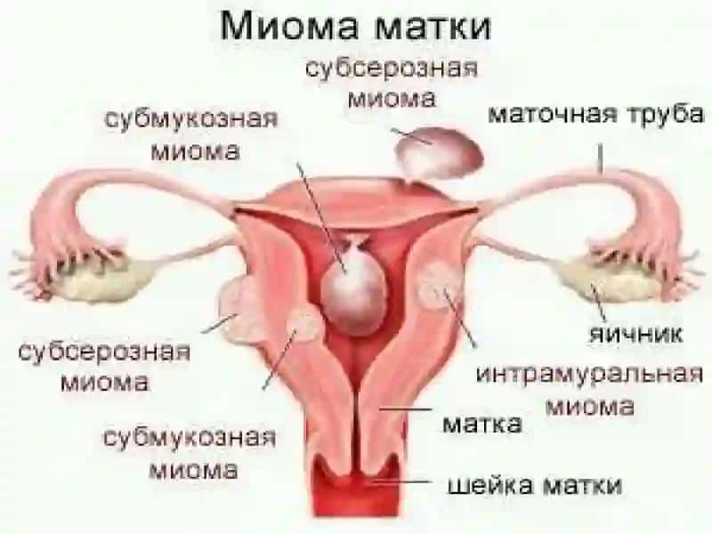 БАЧАДОН МИОМАСИ (BACHADON MIOMASI) 3