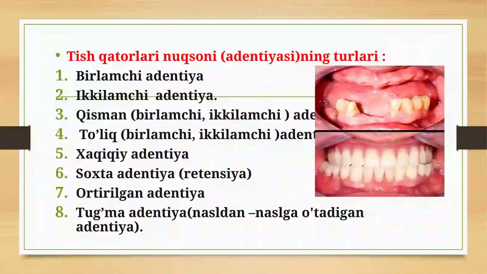 Tish qatorlari qisman nuqsonlari 3
