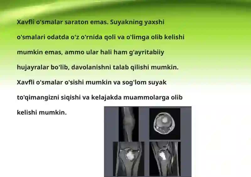 Suyak to'qimasini o'smasi 3