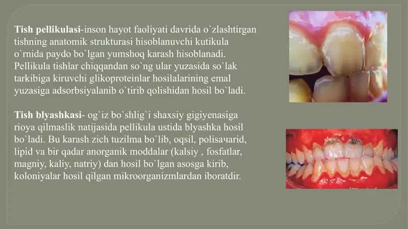 Tishkarashlari va Toshlarini tozalash usullari 3