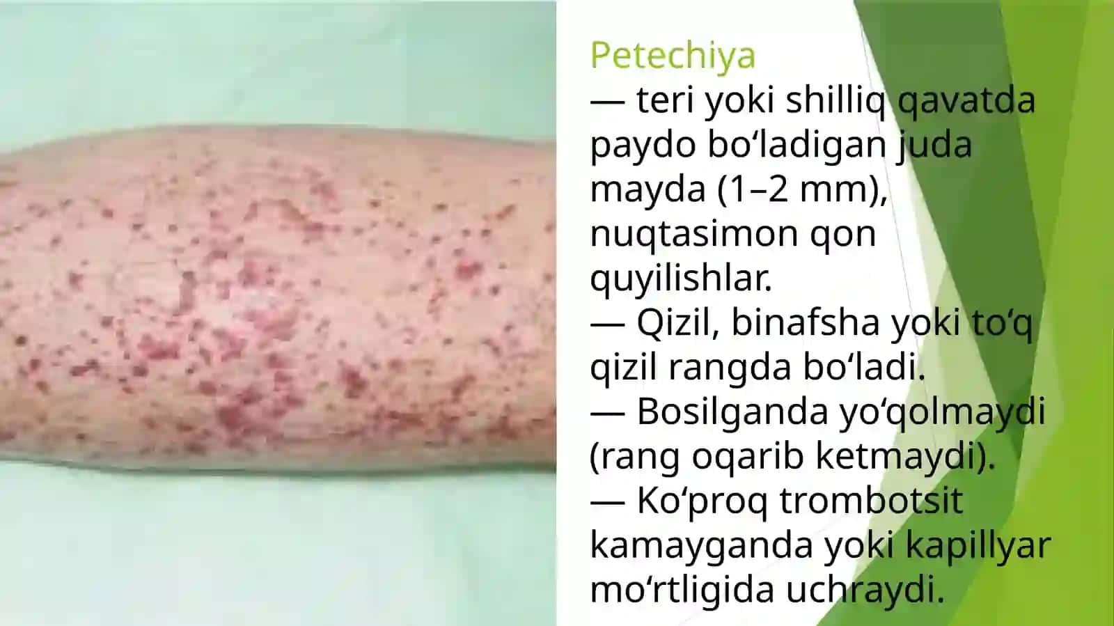Gemoragik diatezlarning ko’rinishlari 3