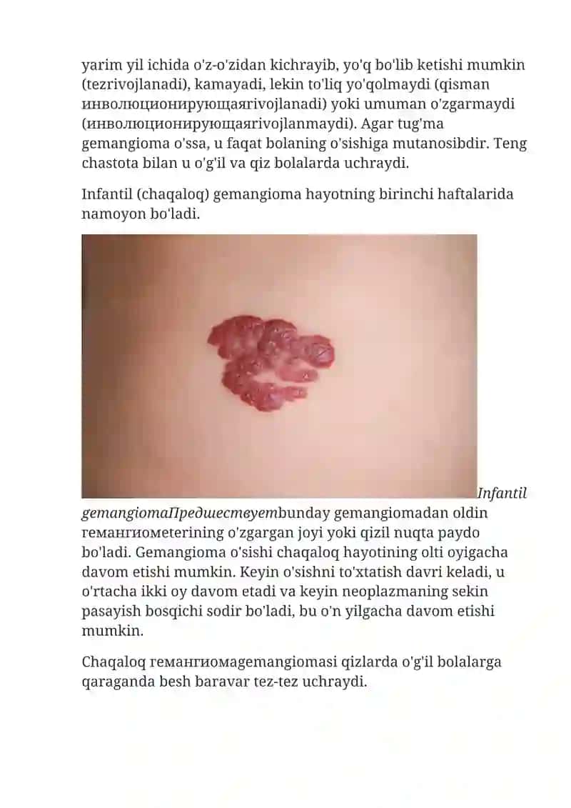 Gemangioma 3