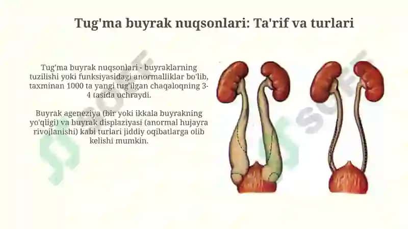 Tug'ma buyrak nuqsonlari 3