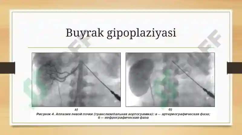 Buyrak gipoplaziyasi 3