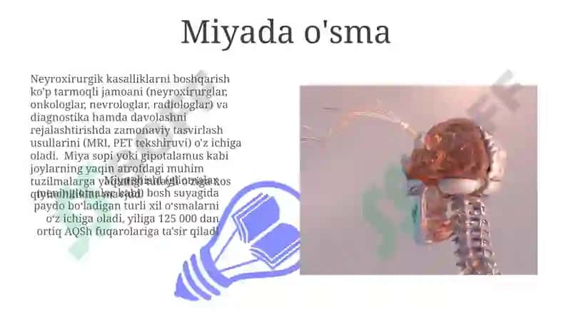 Neyroxirurgik kasalliklari haqida tushuncha 3