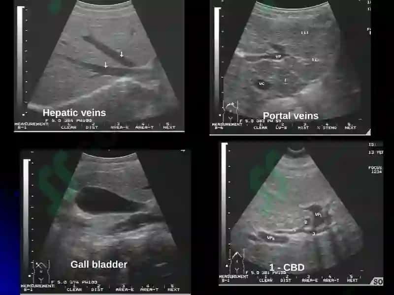 IMAGING OF LIVER DISEASES 3