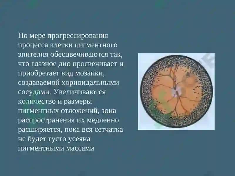 Пигментная дистрофия сетчатки 3