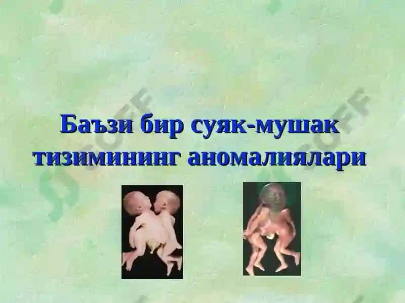 Туғма оёқ-қўл нуқсонлари 3