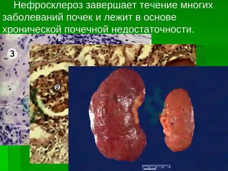 Болезни почек 3