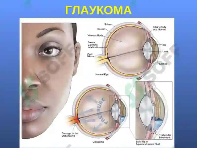 Глаукома 3