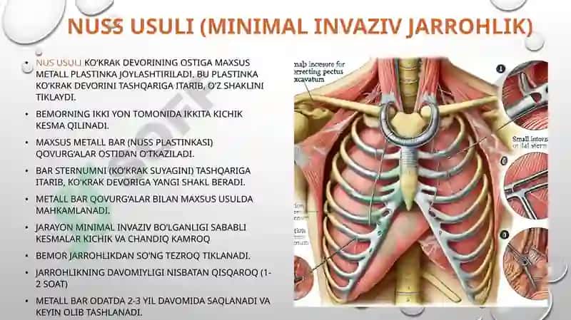 Nususuli(Minimal invaziv jarrohlik) 3