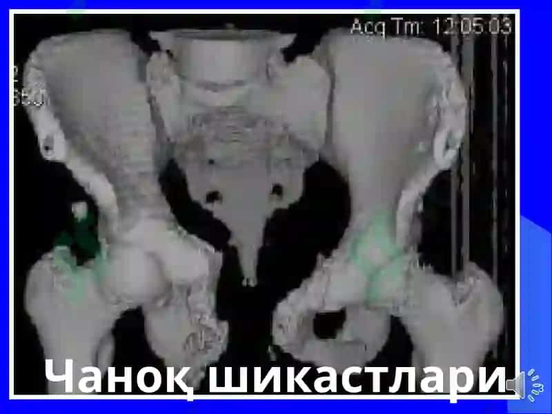 Чаноқ шикастлари 3
