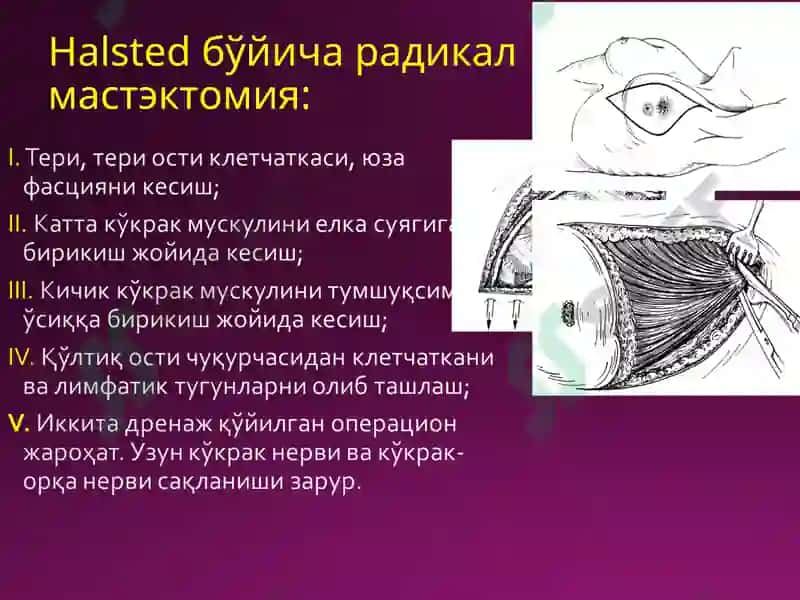 Halsted бўйича радикал мастэктомия 3