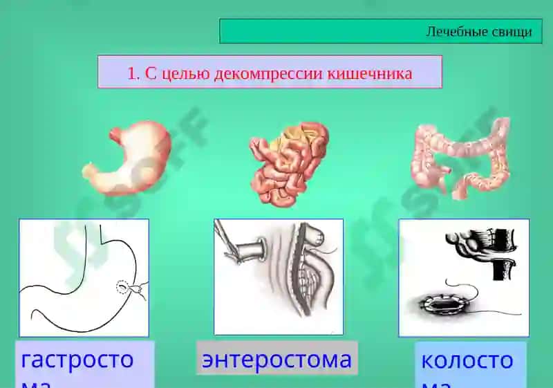 Кишечные свищи 3