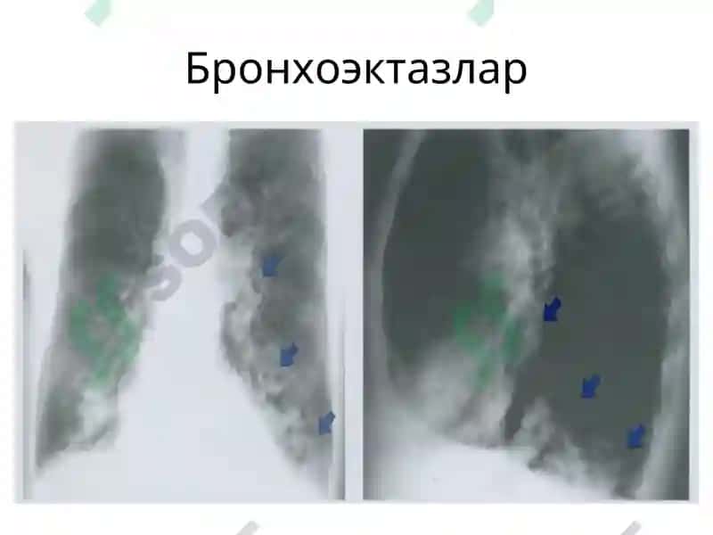 Бронхоэктазлар ва ўпка абсцесслари рентгенограммалари 3