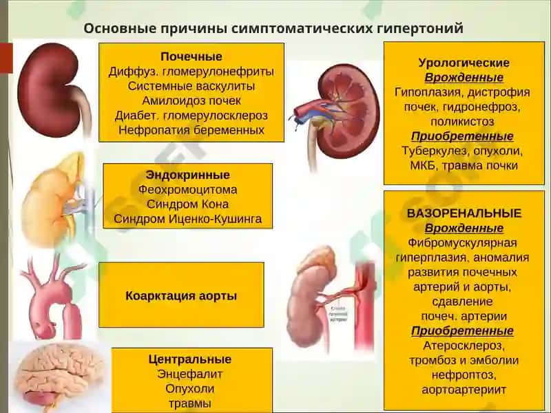 Вазоренальная гипертензия 3