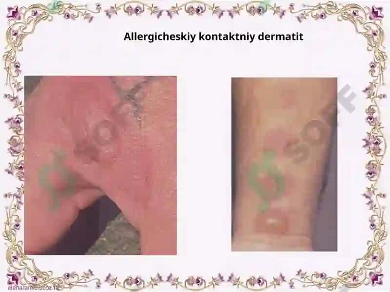 Allergodermatozlar 3