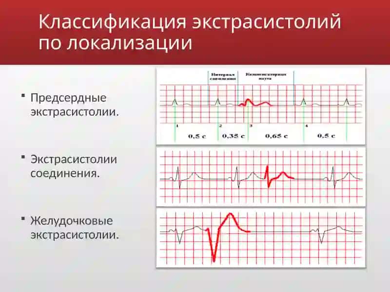 Экстрасистолии 3