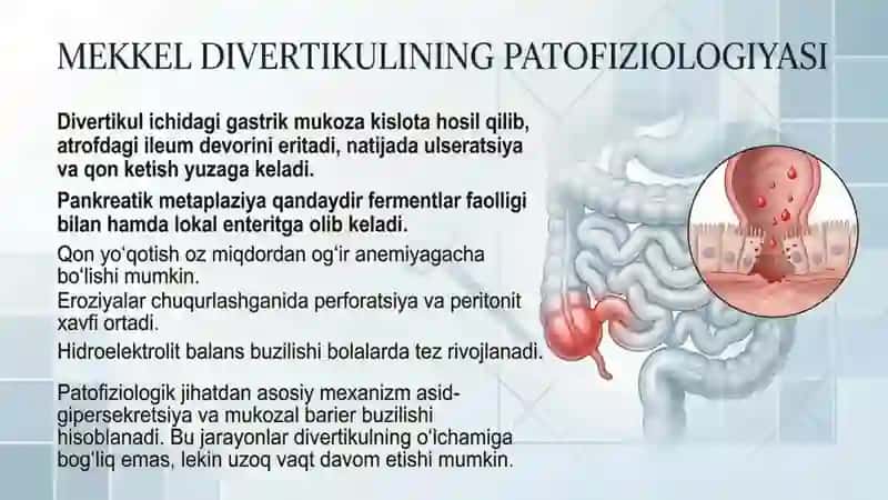Mekkel divertikulini olish operatsiyasi 3