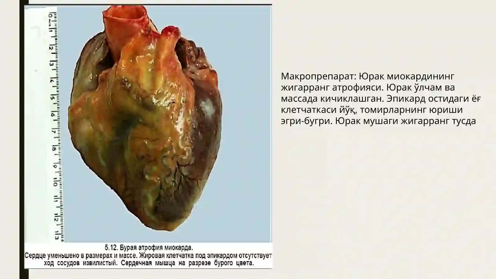Макропрепарат: Сурункали атрофик гастрит 3