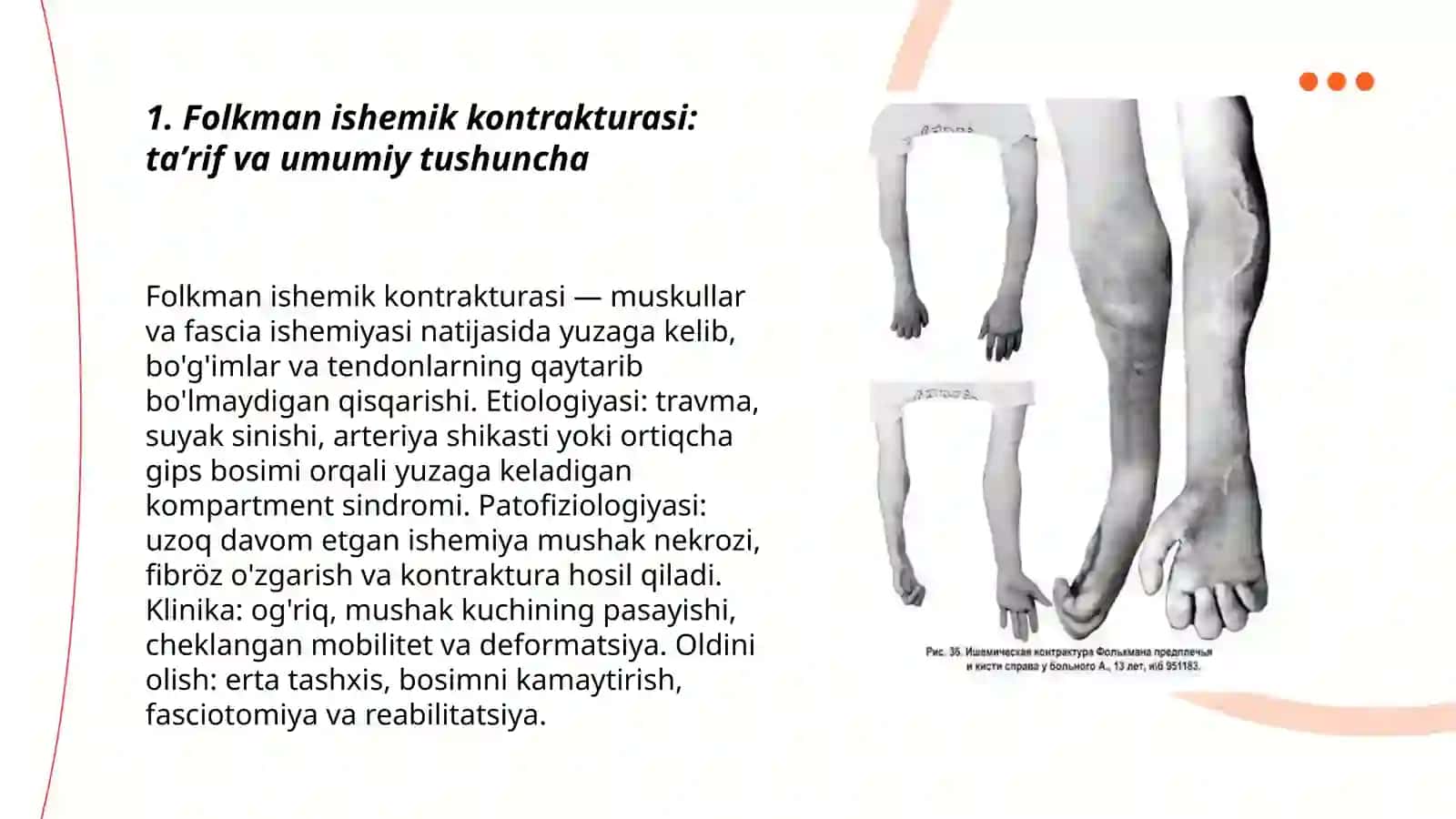 Folkman ishemik kontrakturasi 3