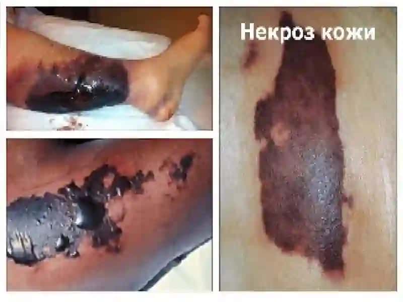 Nekrozvagangrenalar.Qonaylanishiningo’tkirbuzilishlari 3