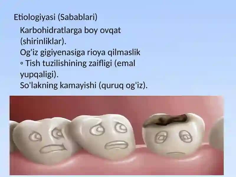 Karies, pulpit, periodontit. Klinikasi tashxisi va davolash 3