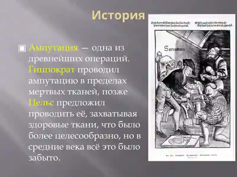Ампутация 3