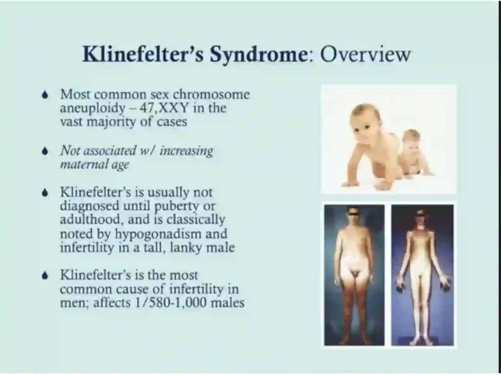 Klinefelter Sindromi 3