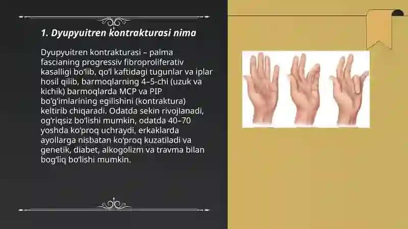 Dyupyuitren kontrakturasi 3