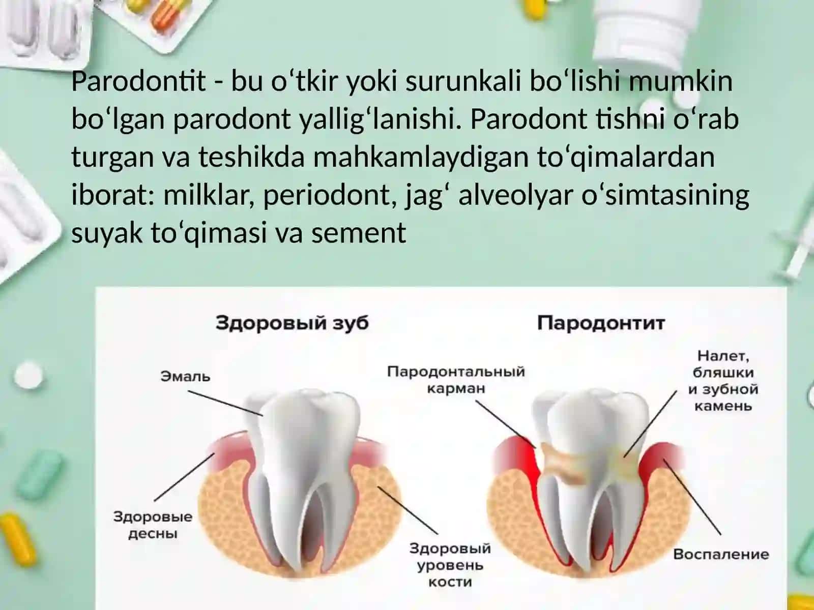Paradontit 3