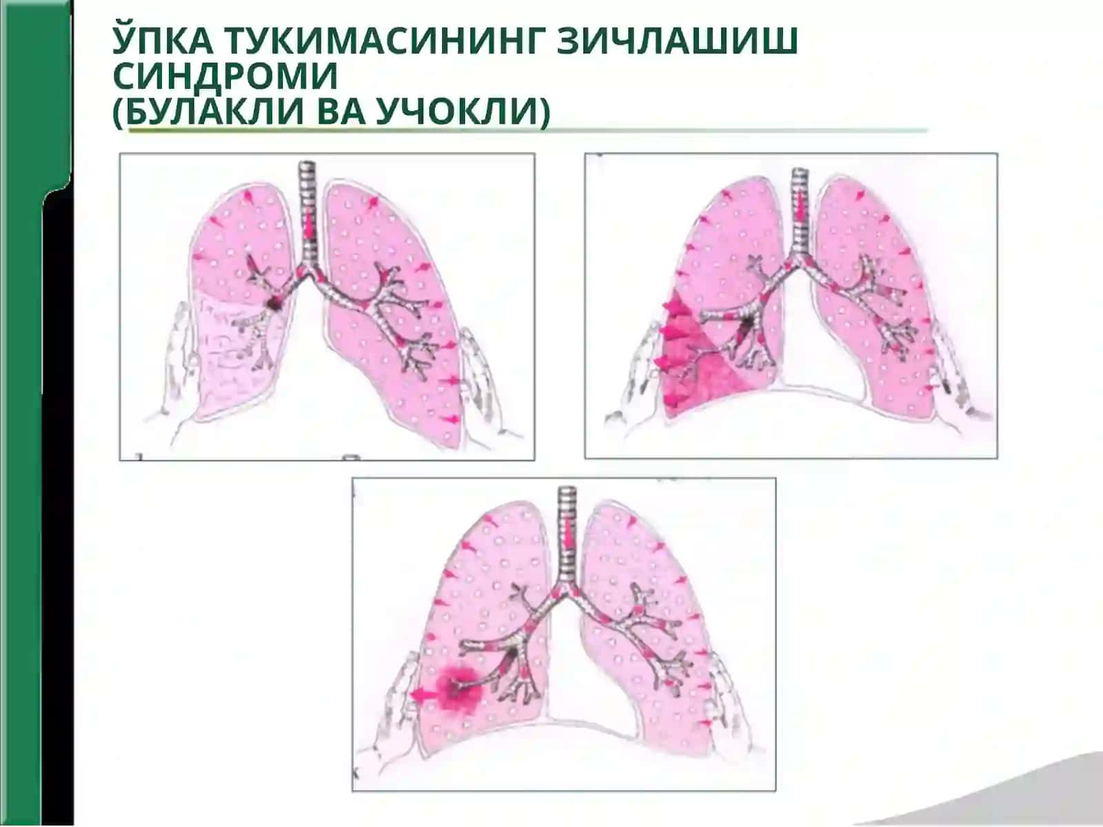НАФАС ОЛИШ ОРГАНИ КАСАЛЛИКЛАРИНИНГАСОСИЙ КЛИНИК СИНДРОМЛАРИ 3