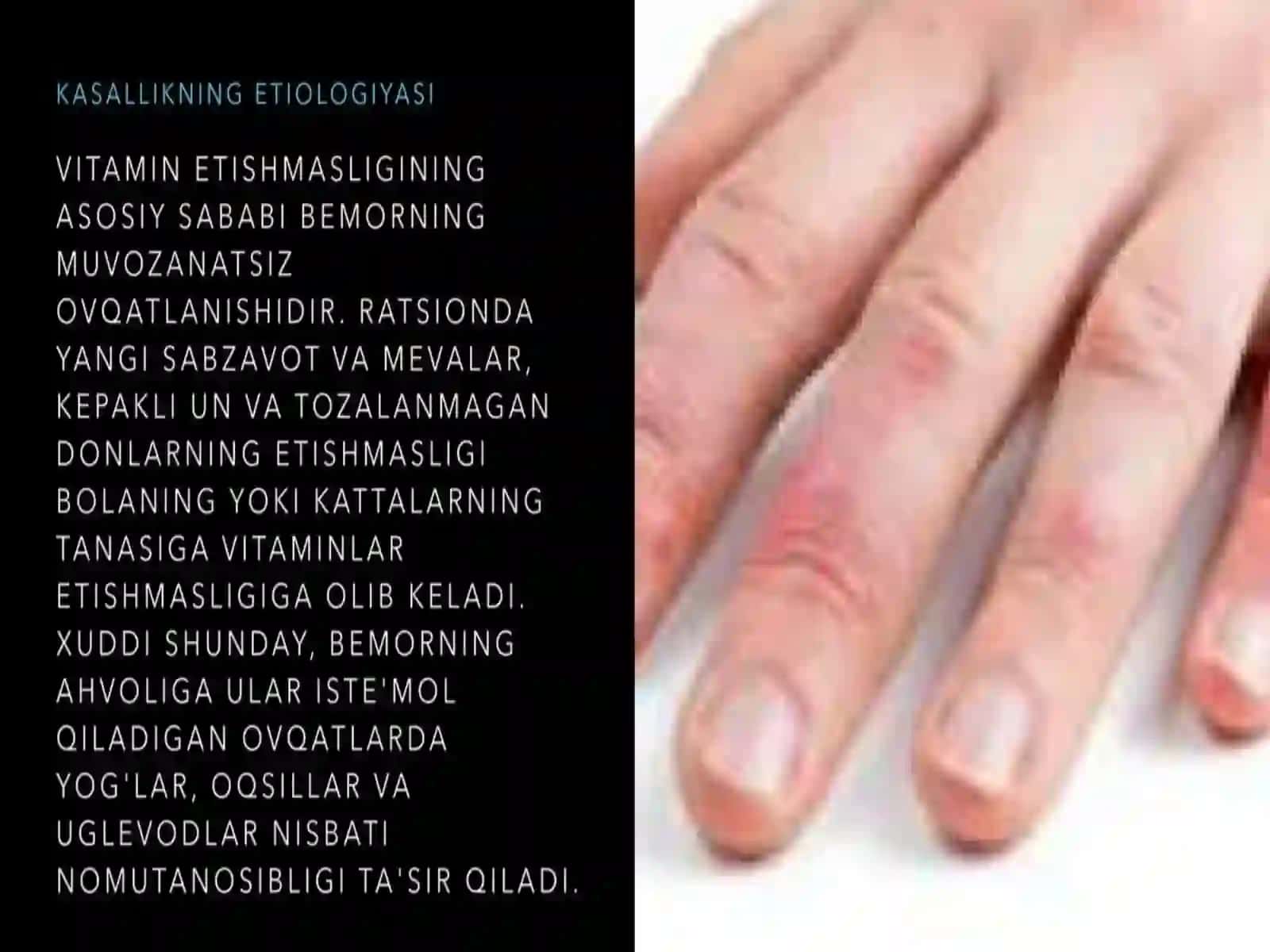 Avitaminoz va gipovitaminoz 3