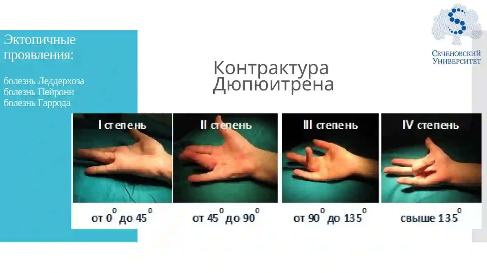 Методы лечения контрактуры Дюпюитрена 3